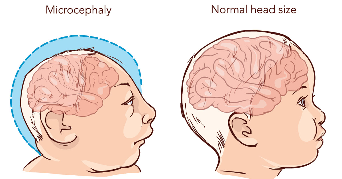 Baby with Microcephaly disease