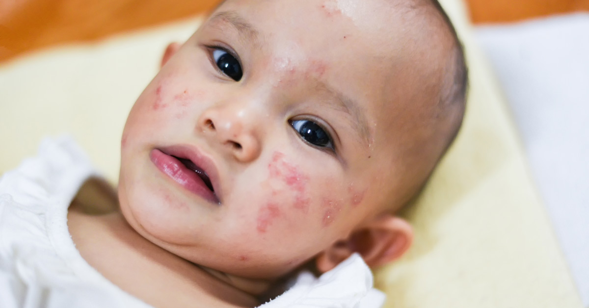 Baby with skin allergy