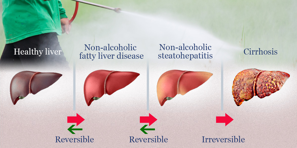 Roundup causes non-alcoholic fatty liver disease at very low doses